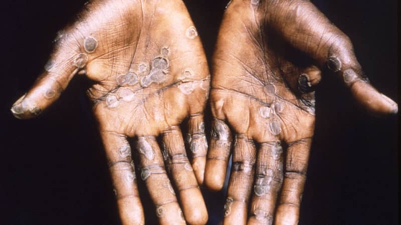 The palms of a monkeypox case patient  in the Democratic Republic of Congo in 1997.