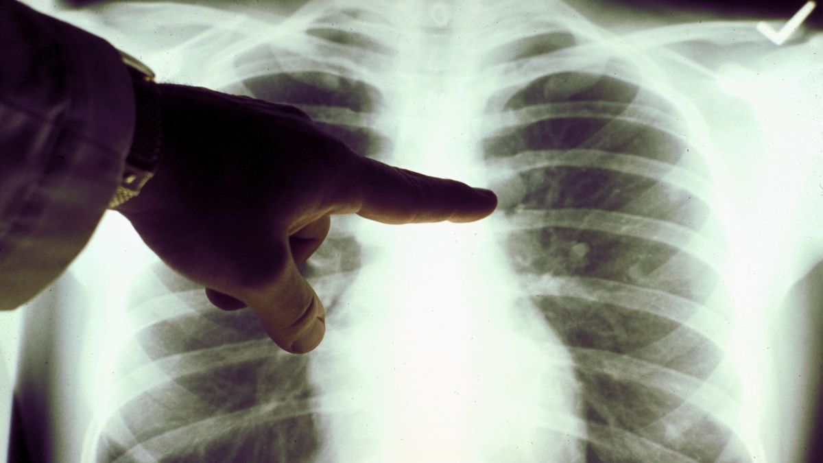 SaludExpress: ¿Cómo ha evolucionado el cáncer de pulmón? - CNN Video