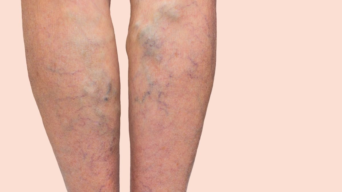 varicose veins: Are you 6-feet tall? Watch out for varicose veins