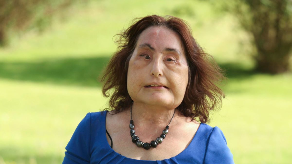 Connie Culp First Us Near Total Face Transplant Recipient Dies At 57 Cnn