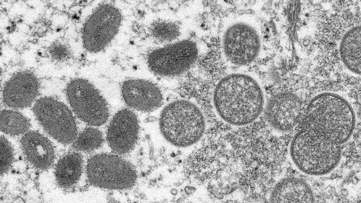 CDC and Massachusetts health officials investigating monkeypox case