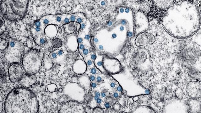 Transmission electron microscopic image of an isolate from the first US case of coronavirus. The spherical viral particles, colorized blue, contain cross-section through the viral genome, seen as black dots.