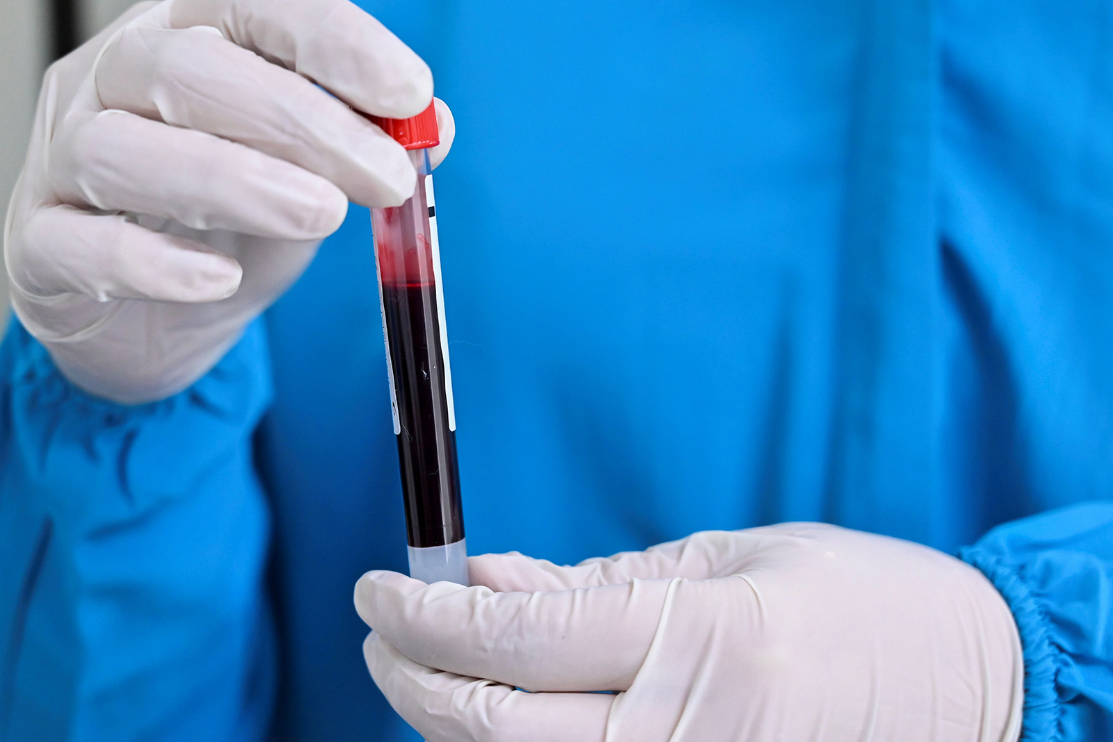 A health worker holds a blood sample in the Versalles Clinic, on June 25, in Cali, Colombia.