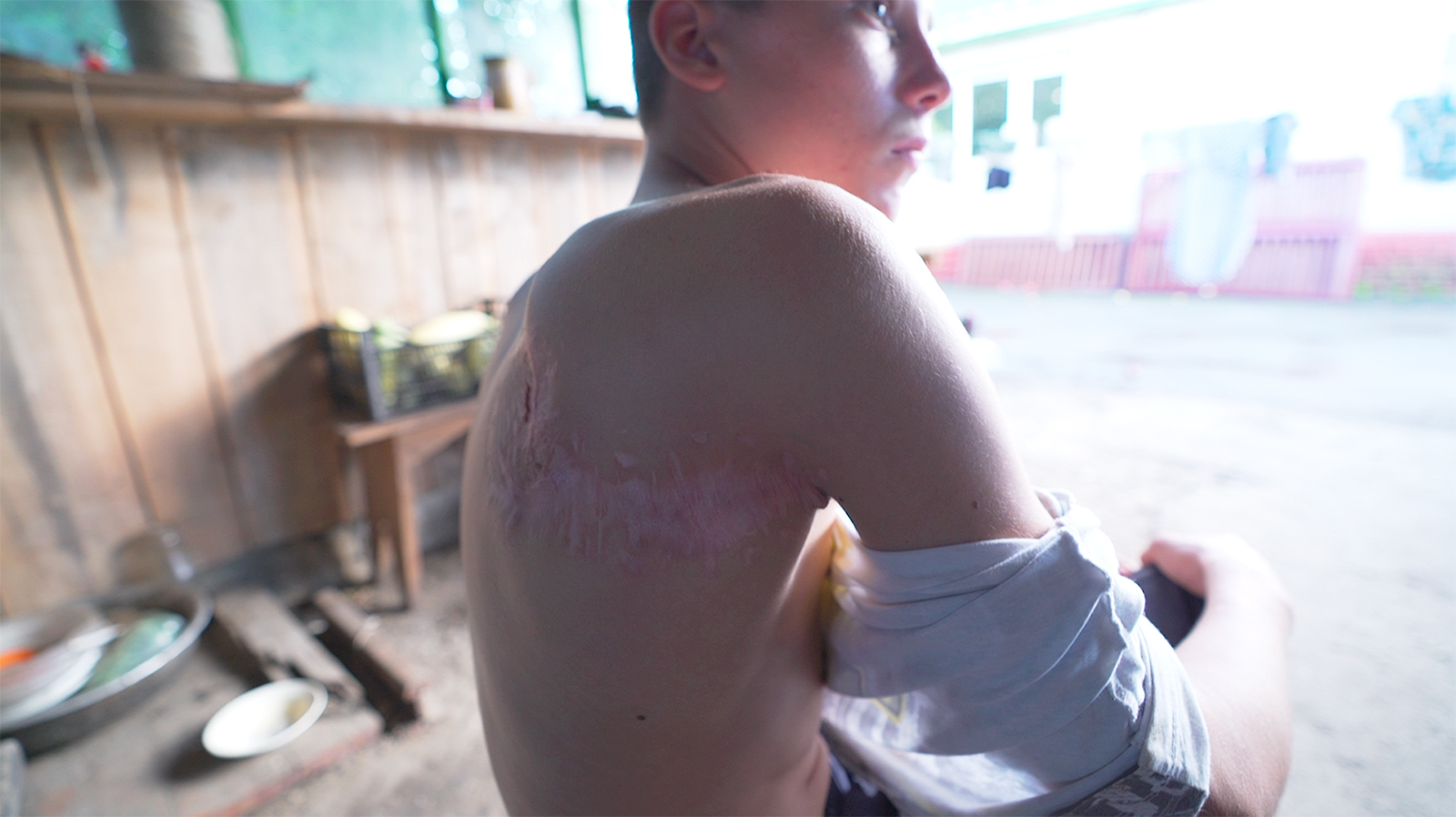 Terluka oleh perang, bekas luka pada anak-anak yang terluka di Ukraina lebih dari sekadar kulit