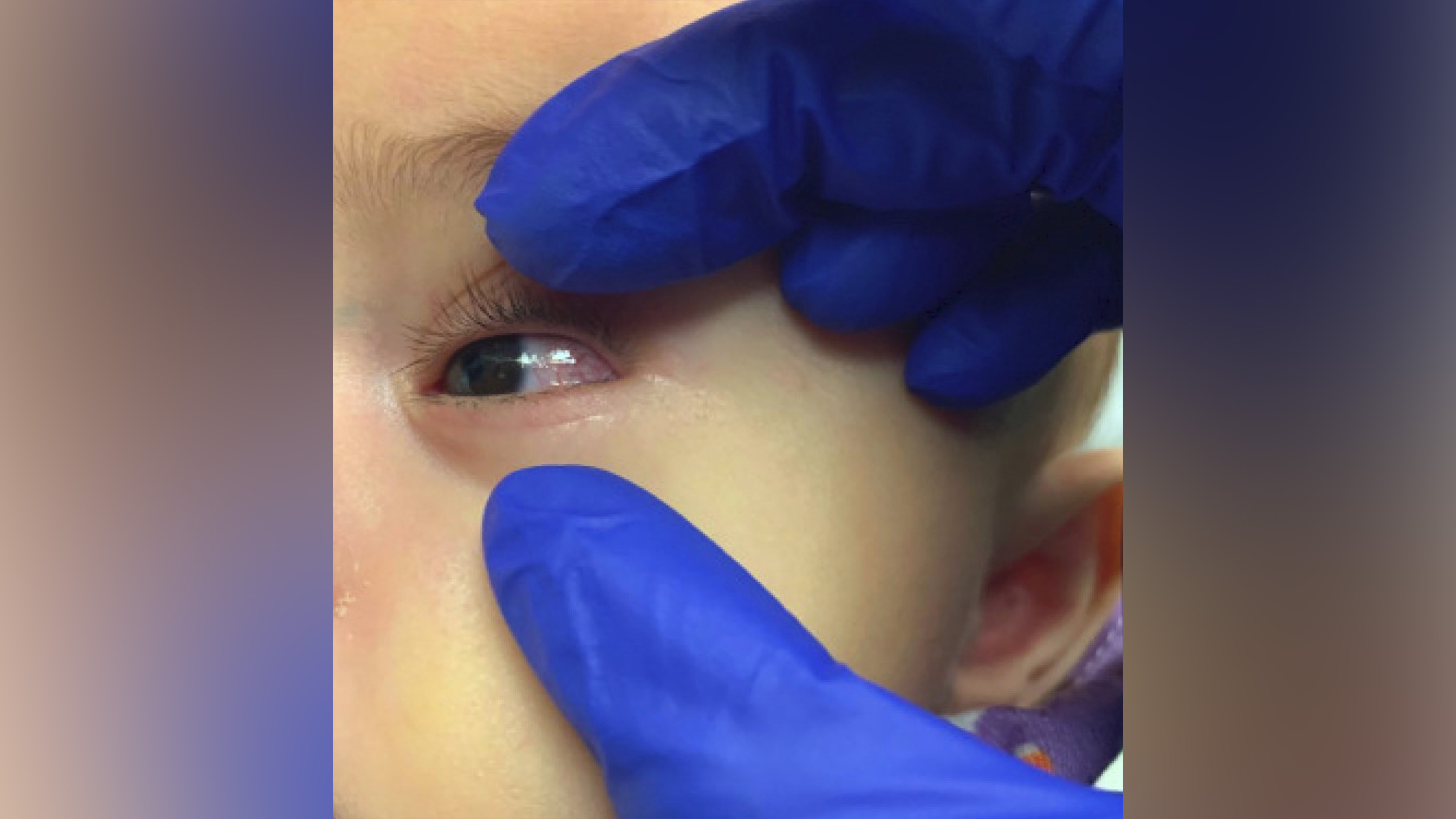 Bulbar conjunctival injection is shown in the case study of a 6-month-old infant admitted and diagnosed with classic Kawasaki disease, who also screened positive for Covid-19 in the setting of fever and minimal respiratory symptoms. 