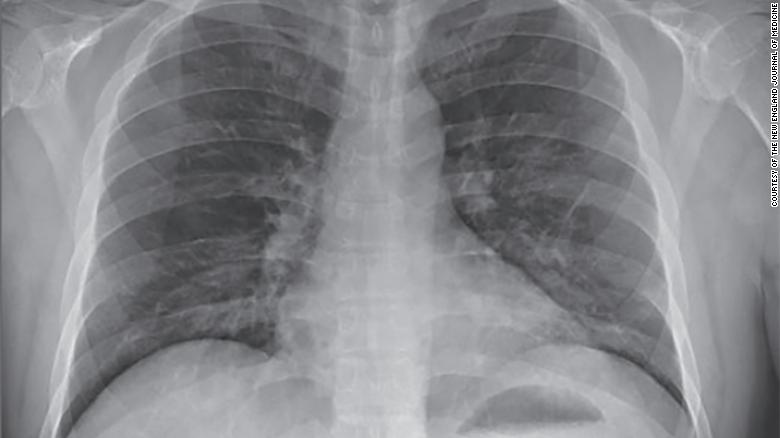 On his fifth day in the hospital, doctors saw signs of pneumonia in the coronavirus patient's lungs.