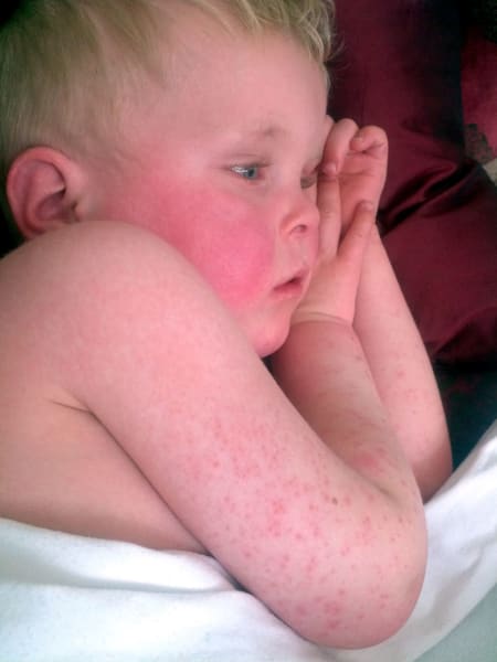 small child sick with scarlet fever