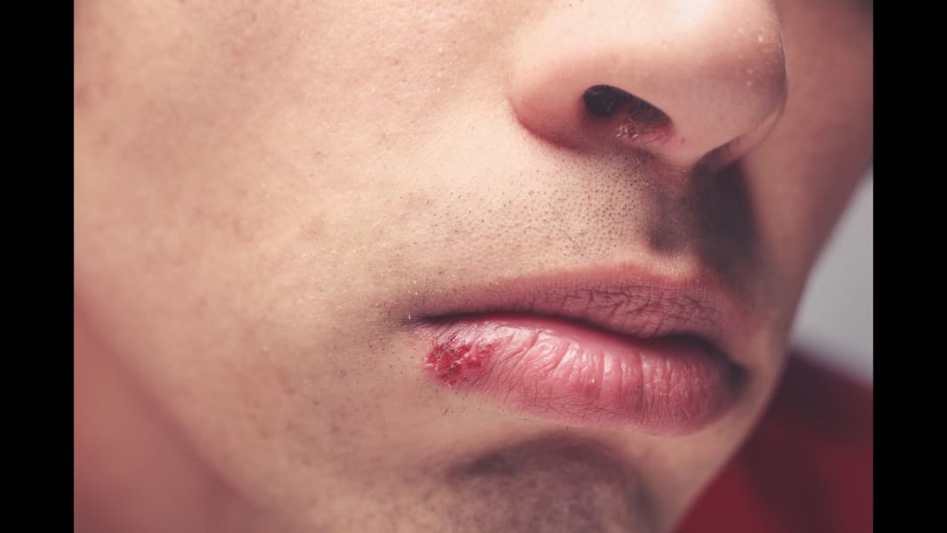 Kissing after sore tongue Bit Tongue