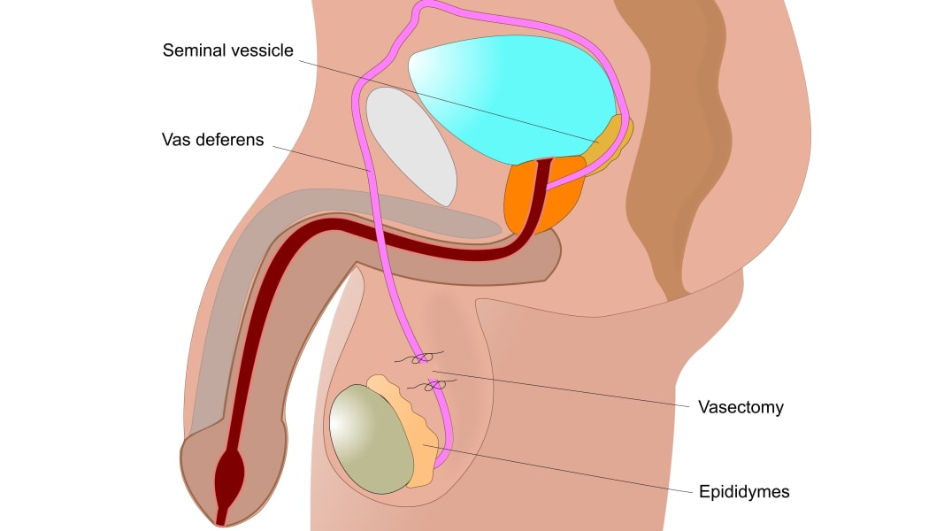 Vasectomy STOCK