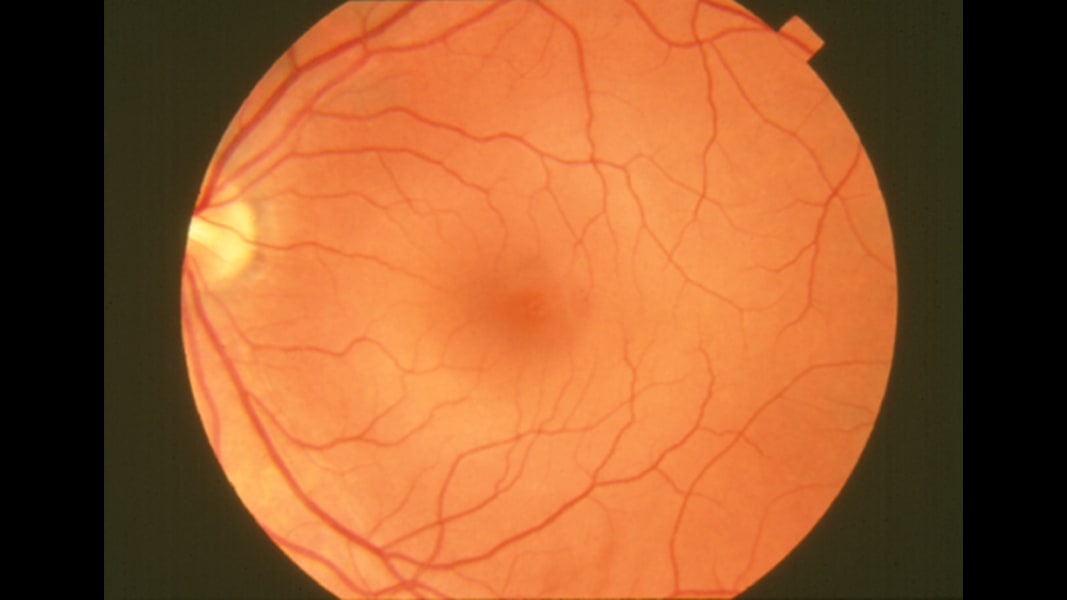 02 eye predicts health conditions normal retina