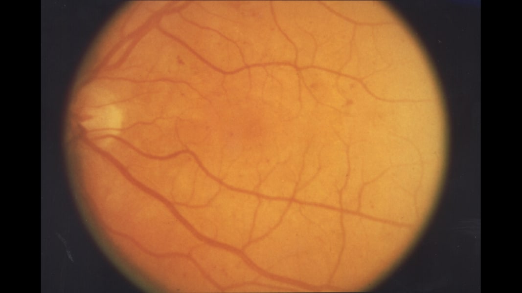 03 eye predicts health conditions retinopathy