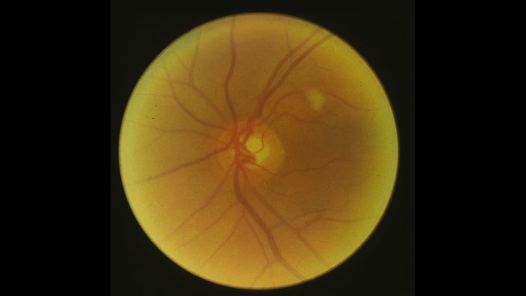 07 eye predicts health conditions glaucoma