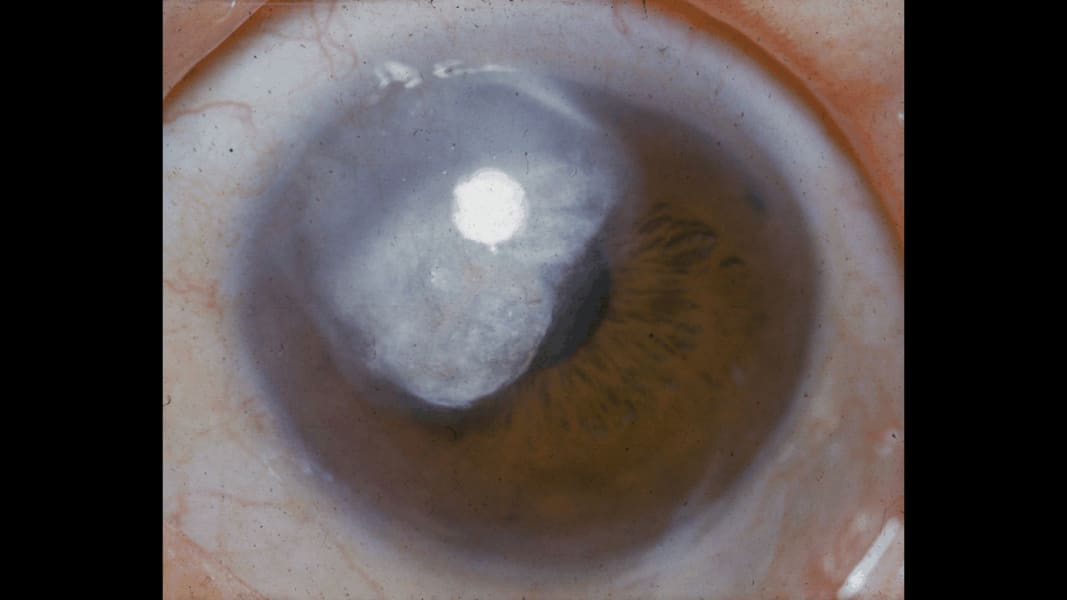 08 eye predicts health conditions glaucoma